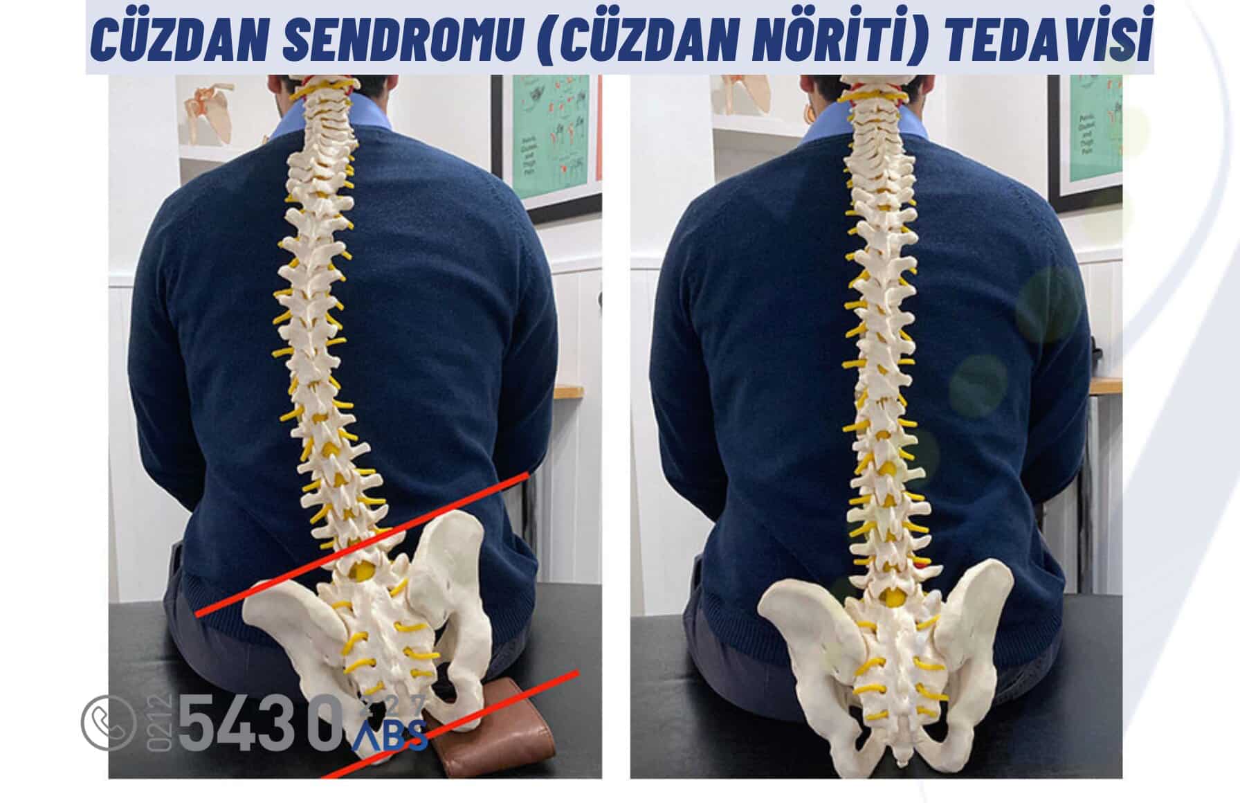 Cüzdan Sendromu (Cüzdan Nöriti) Tedavisinde Fizyoterapi