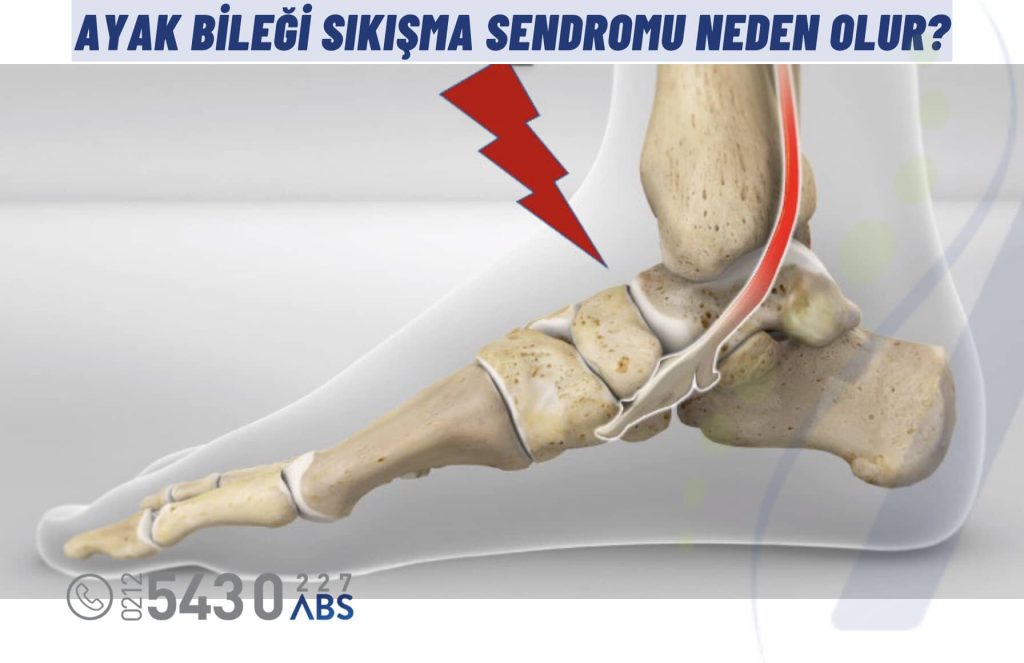 Ayak bileği sıkışma sendromunda ayak bileği ön kısmında hissedilen ağrıyı temsil eden görsel.