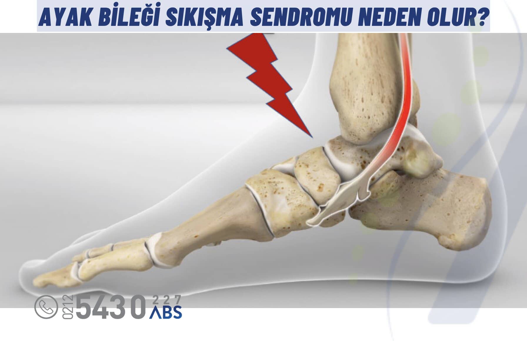 Ayak Bileği Sıkışma Sendromu Neden Olur?